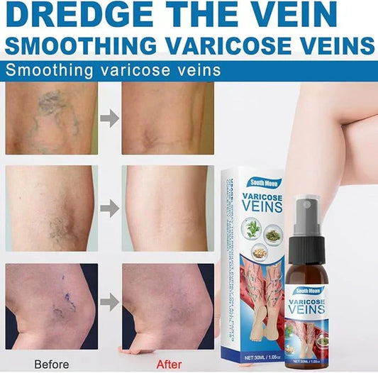 South Moon - Varicose Veins